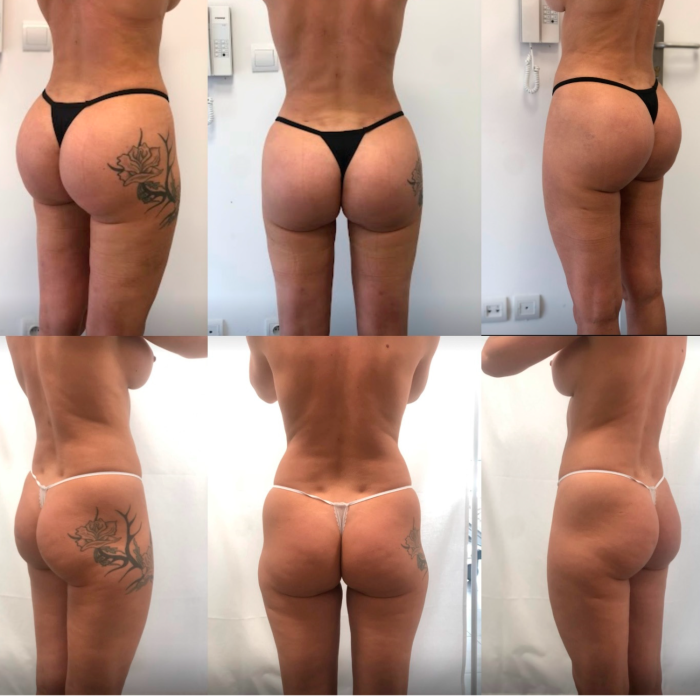 Buy 1000CC PMMA BUTTOCK INJECTIONS 1000CC PMMA BUTTOCK INJECTIONS