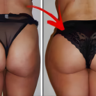 2000CC PMMA BUTTOCK INJECTION