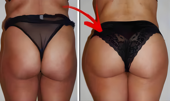 Buy 2000CC PMMA BUTTOCK INJECTION 2000CC PMMA BUTTOCK INJECTION
