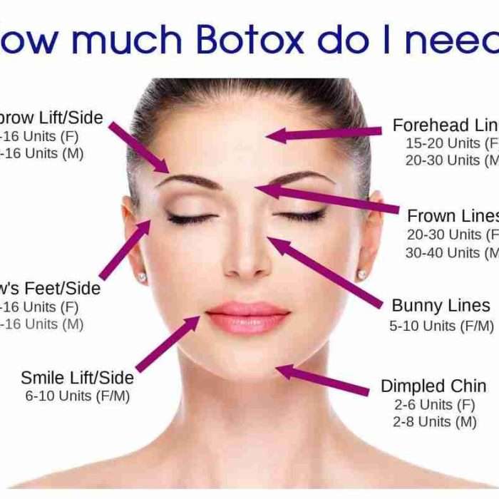 Buy Allergan – Therapeutic / Cosmetic – Botox, 100 Units/Vial Allergan – Therapeutic / Cosmetic – Botox, 100 Units/Vial