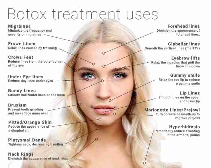 Buy Allergan – Therapeutic / Cosmetic – Botox, 100 Units/Vial Allergan – Therapeutic / Cosmetic – Botox, 100 Units/Vial