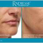 Radiesse 3ml – Purchase Dermal Filler for Volume