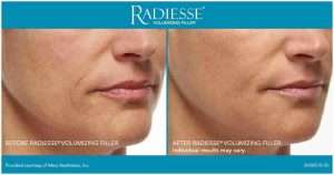 Buy Radiesse 3ml – Purchase Dermal Filler for Volume Radiesse 3ml – Purchase Dermal Filler for Volume