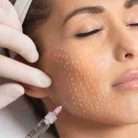 Bio-Revitalisation Skin Treatment