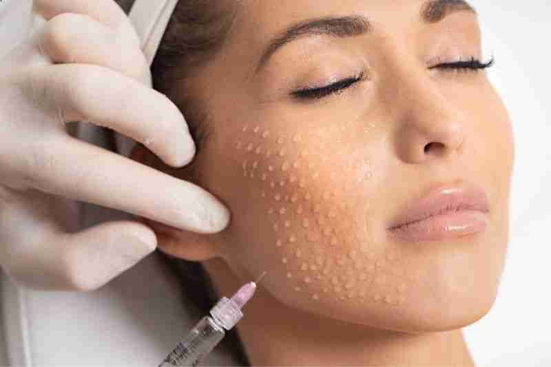 Buy Bio-Revitalisation Skin Treatment Bio-Revitalisation Skin Treatment